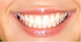 close-up of patient’s smile after getting tooth-colored fillings