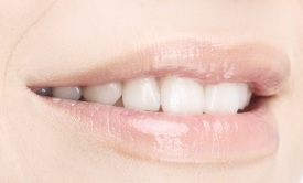 close-up of patient’s smile after receiving an inlay or onlay