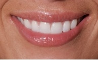 close-up of patient’s smile after getting a dental crown