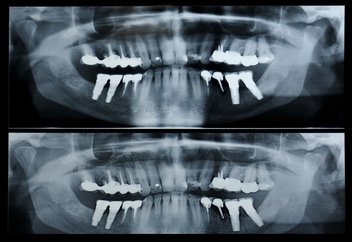 Panorex 360 degree x-rays